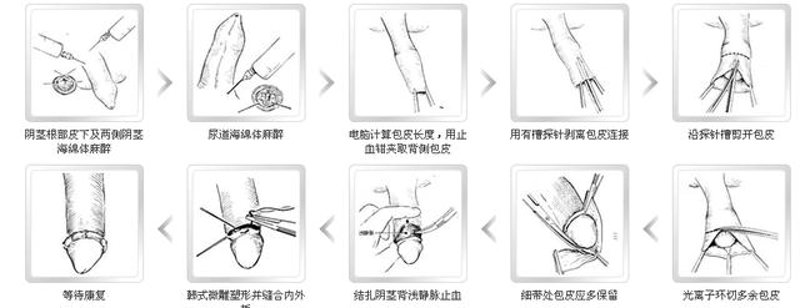包皮环切术